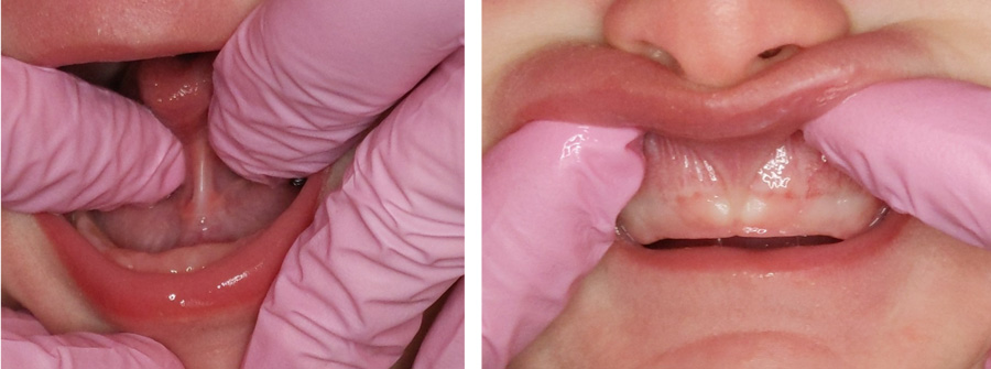 Pictures of Sebastian's tongue-tie (left) and lip-tie (right).
